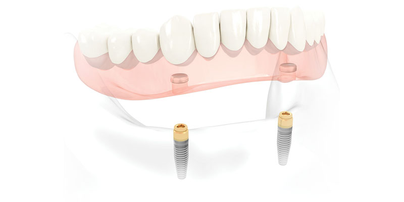 Sobredentaduras removíveis sobre Implantes na PERFECT SMILE